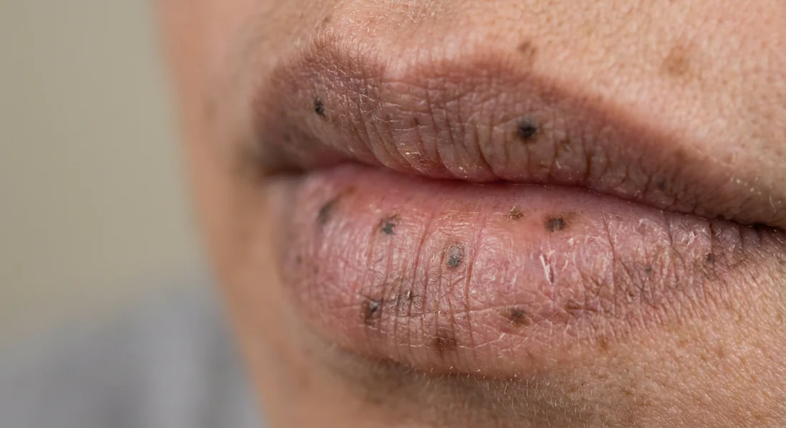 Détail de la pigmentation des lèvres causée par le tabagisme