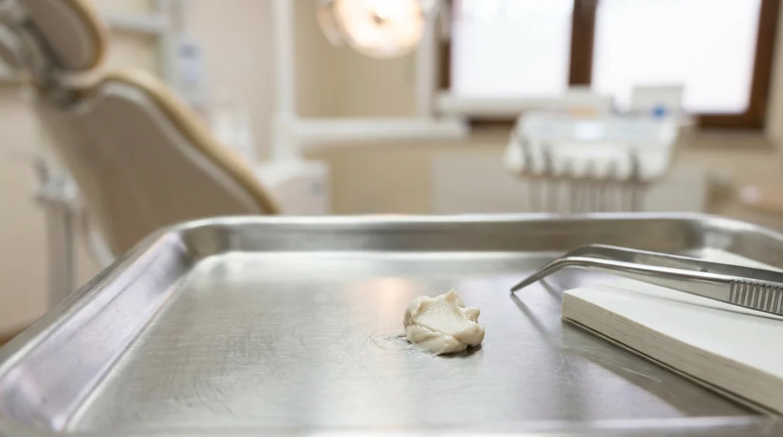 Gros plan sur un pansement dentaire temporaire dans un cabinet médical.